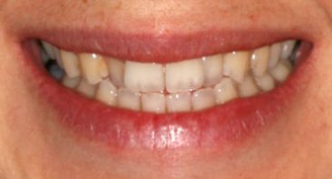 close up of adult prior to treatment with crooked teeth and dark teeth